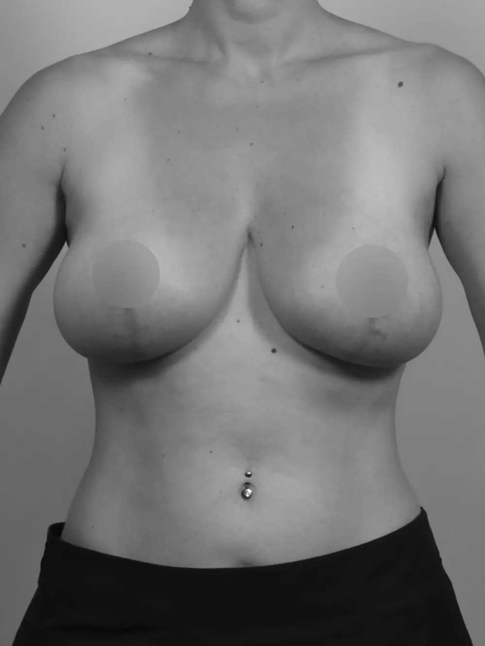 Breast Lift before and after - after