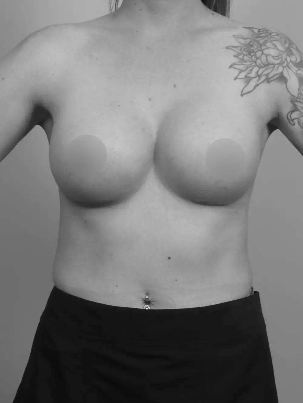 Breast Augmentation before and after - after