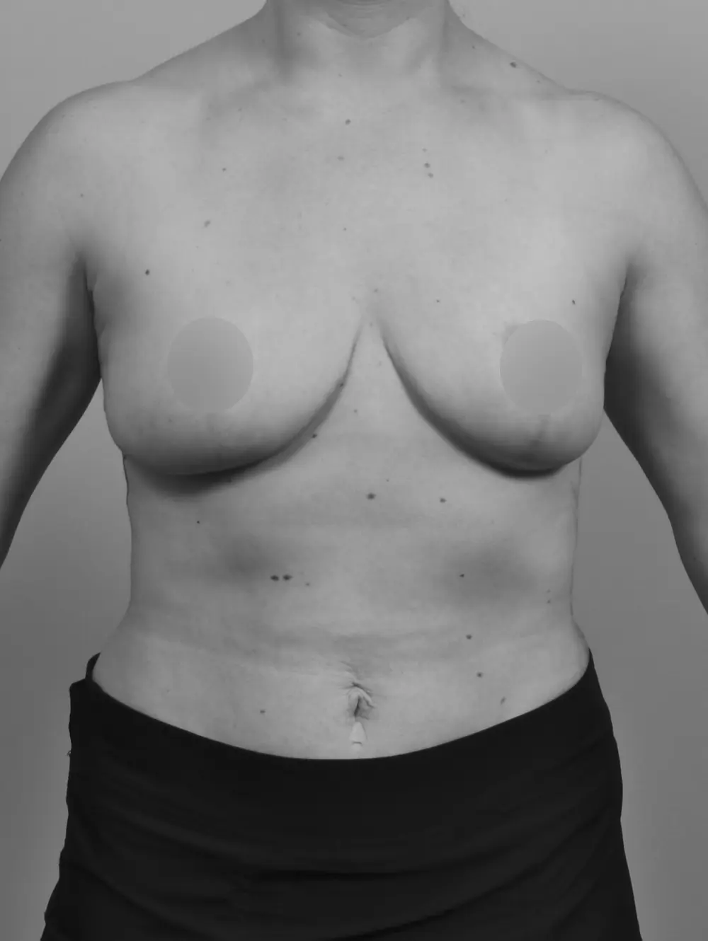Breast Lift before and after - after