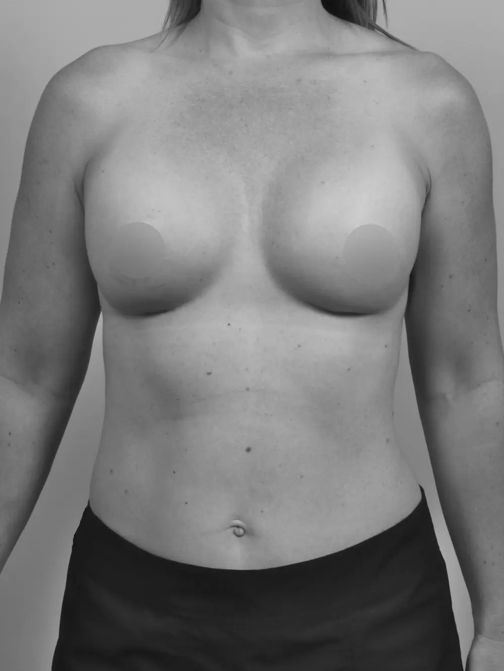 Breast Augmentation before and after - after