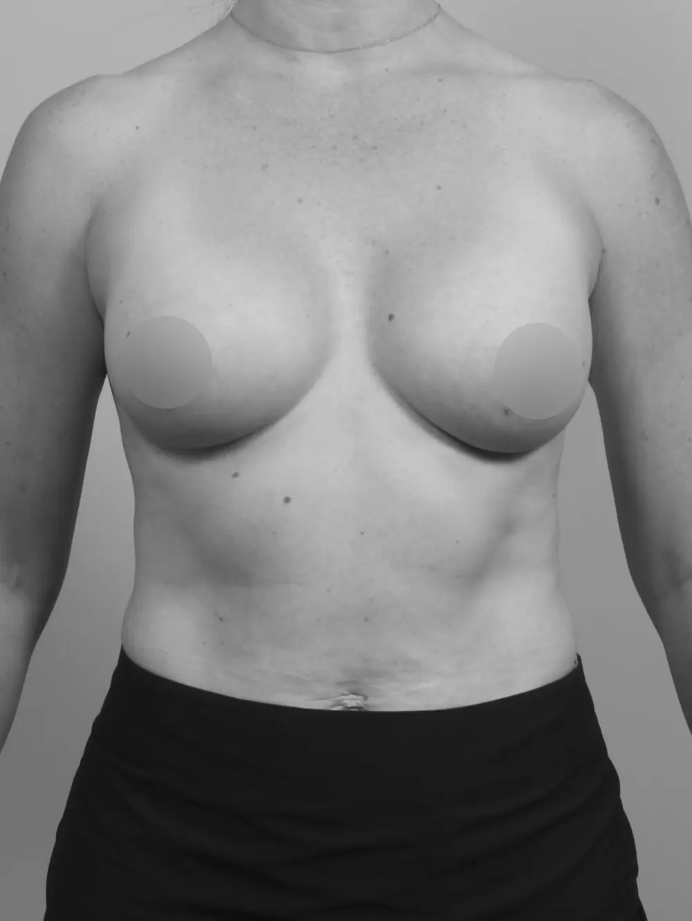 Breast Augmentation before and after - after