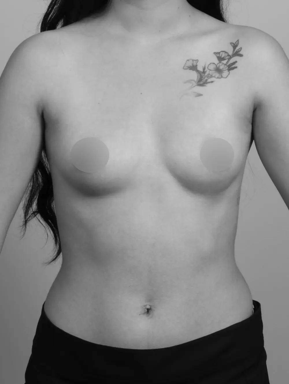 Breast Augmentation before and after - before