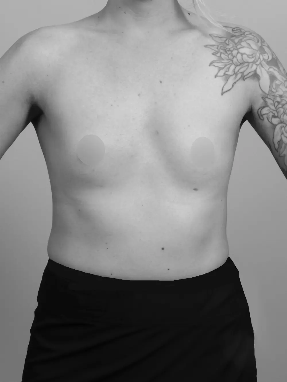 Breast Augmentation before and after - before
