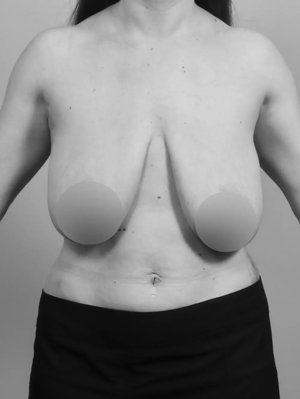 Breast Lift before and after - before
