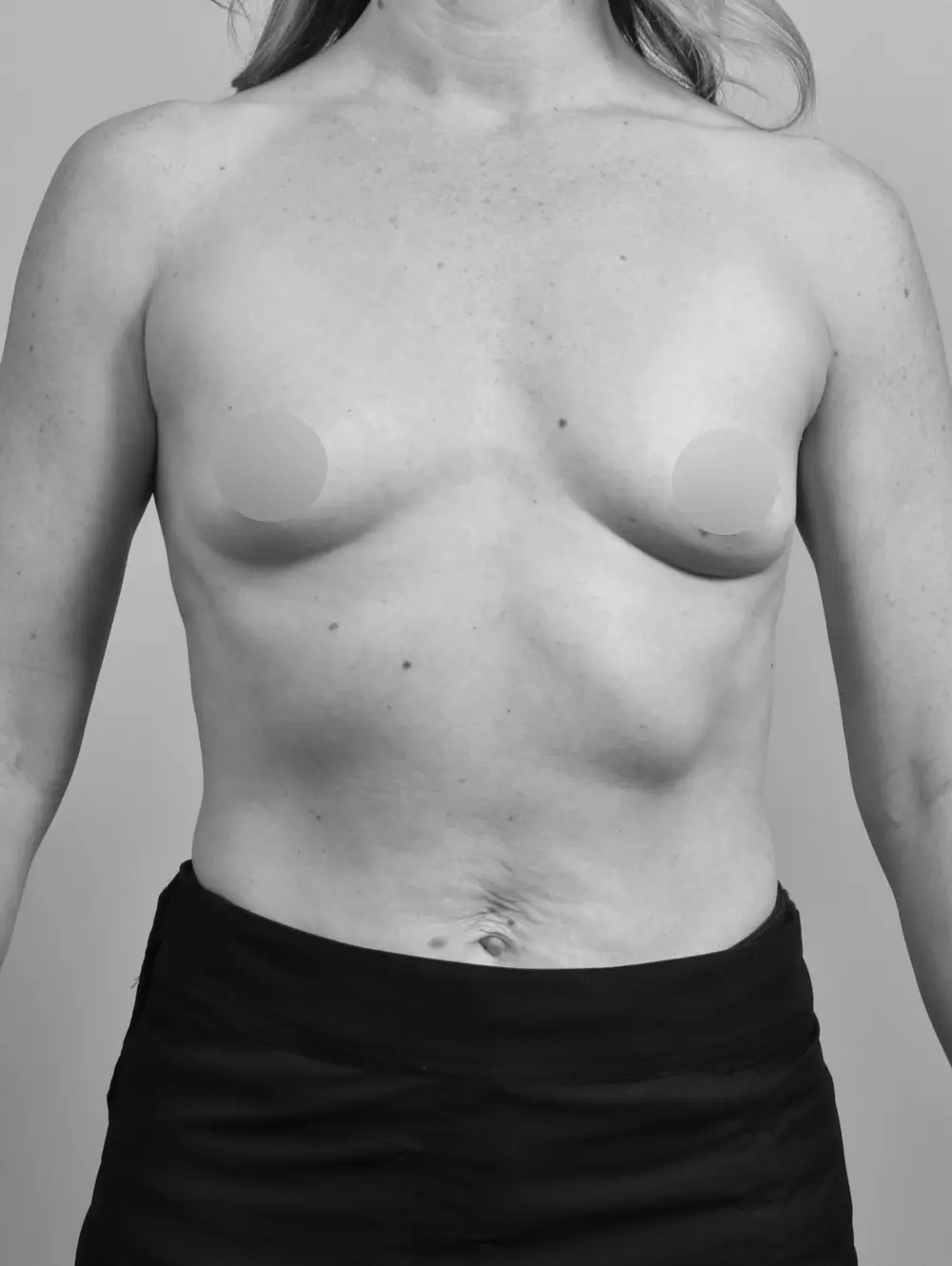 Breast Augmentation before and after - before
