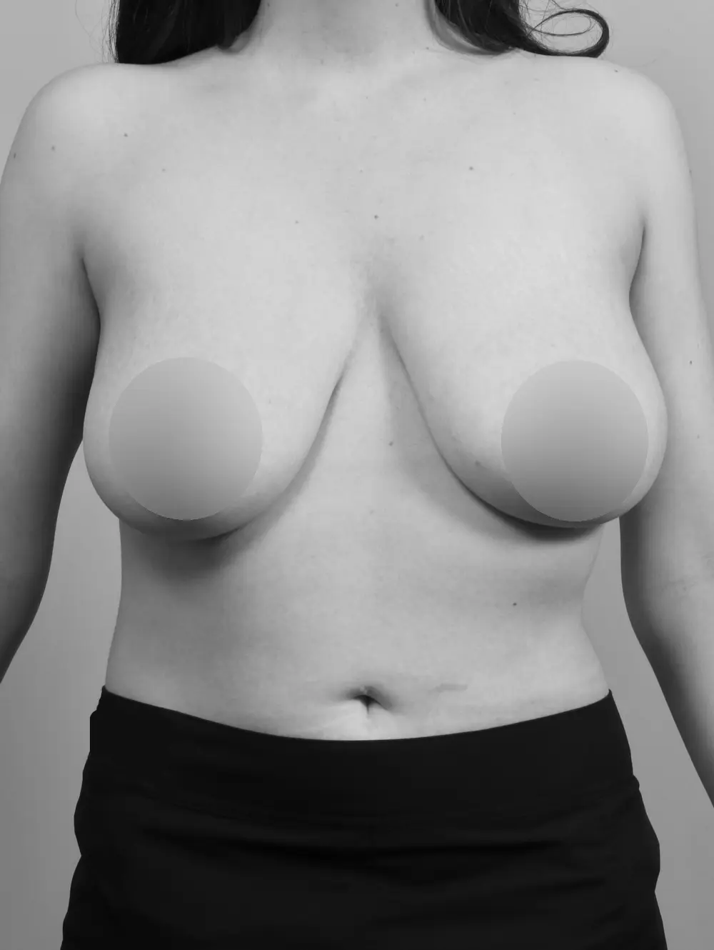 Breast Lift before and after - before