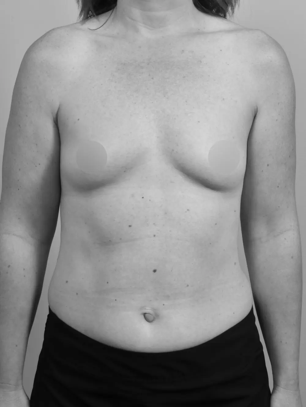 Breast Augmentation before and after - before