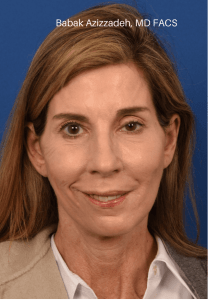 Procedure before and after - after