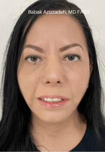 Procedure before and after - after
