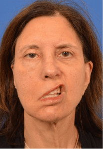 Procedure before and after - before