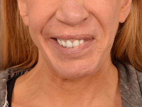 Procedure before and after - before