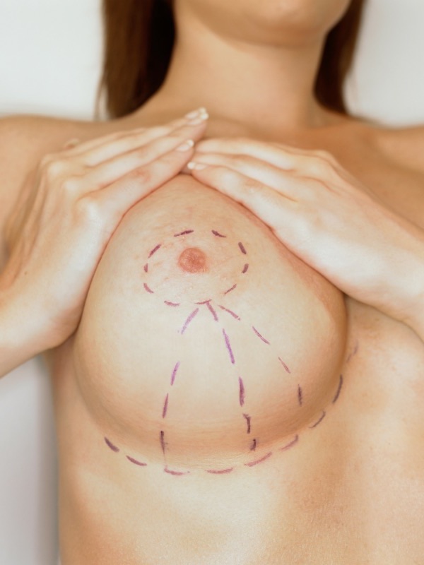 Breast Reduction before and after - after