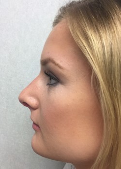 Procedure before and after - after