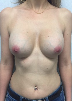 Procedure before and after - after