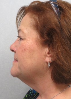 Procedure before and after - after