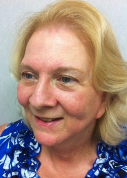 Facelift before and after - after