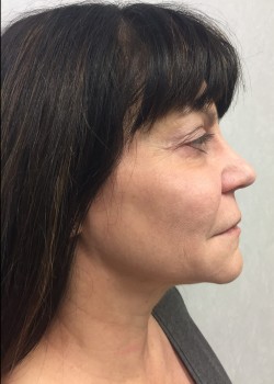 Procedure before and after - after