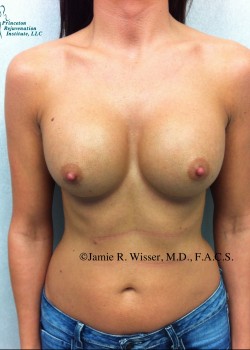 Procedure before and after - after