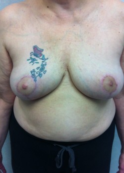 Procedure before and after - after
