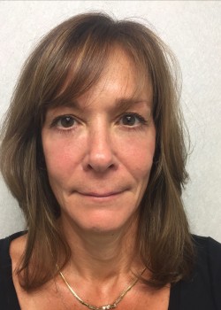 Procedure before and after - after