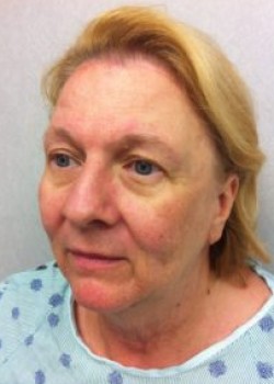Facelift before and after - before