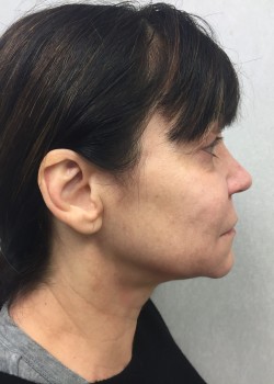 Procedure before and after - before
