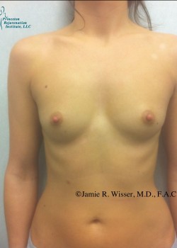 Procedure before and after - before