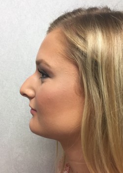 Procedure before and after - before