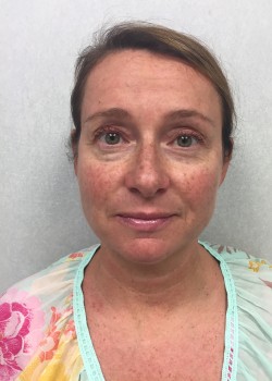 Procedure before and after - before