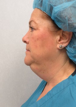 Procedure before and after - before