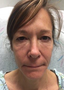 Procedure before and after - before