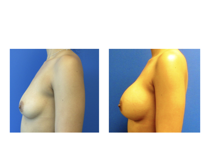 Breast Augmentation before and after - after