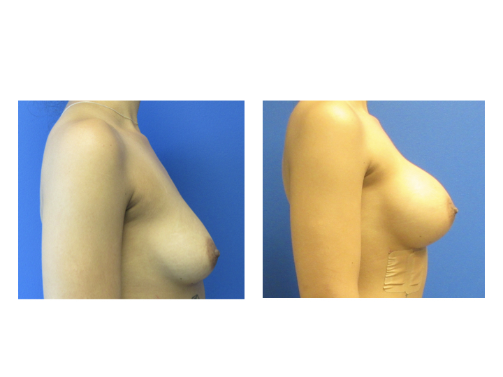 Breast Augmentation before and after - after