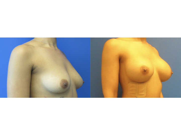 Breast Augmentation before and after - after
