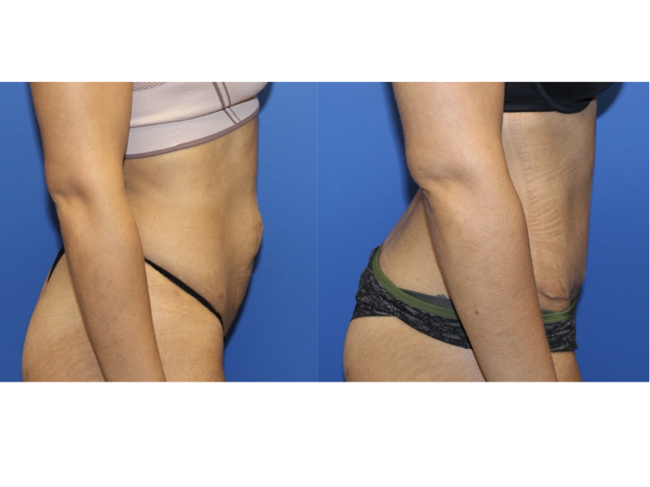 Breast Augmentation before and after - before