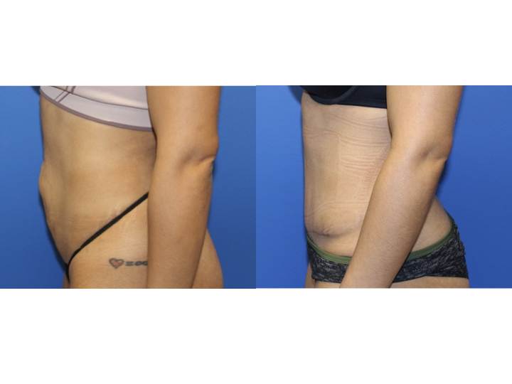 Abdominoplasty before and after - before