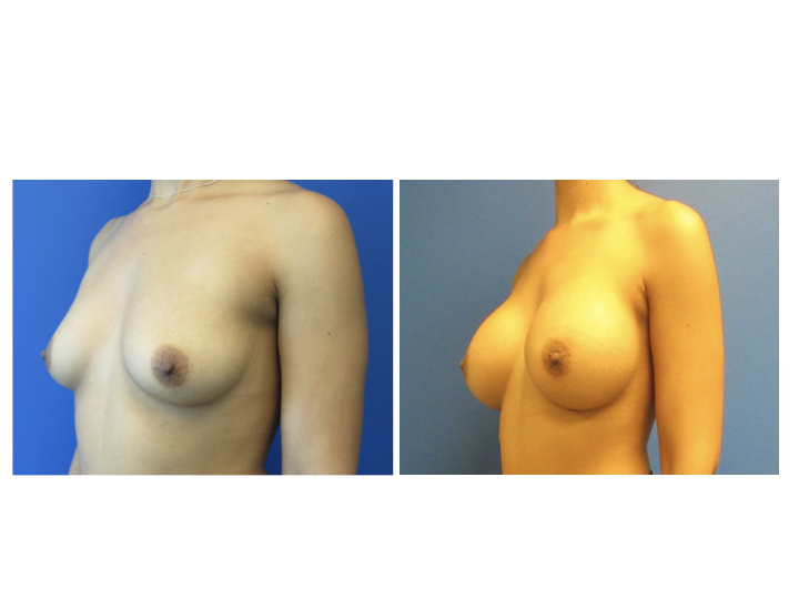Breast Augmentation before and after - before