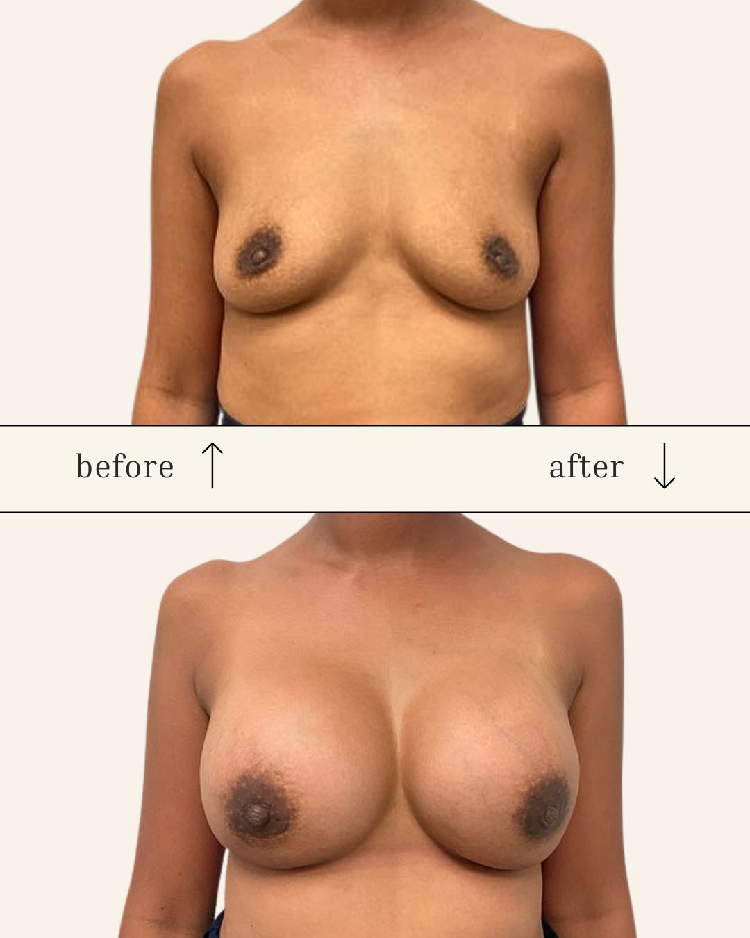 Breast Augmentation before and after - after