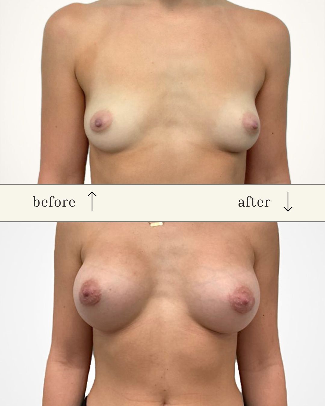 Breast Augmentation before and after - after