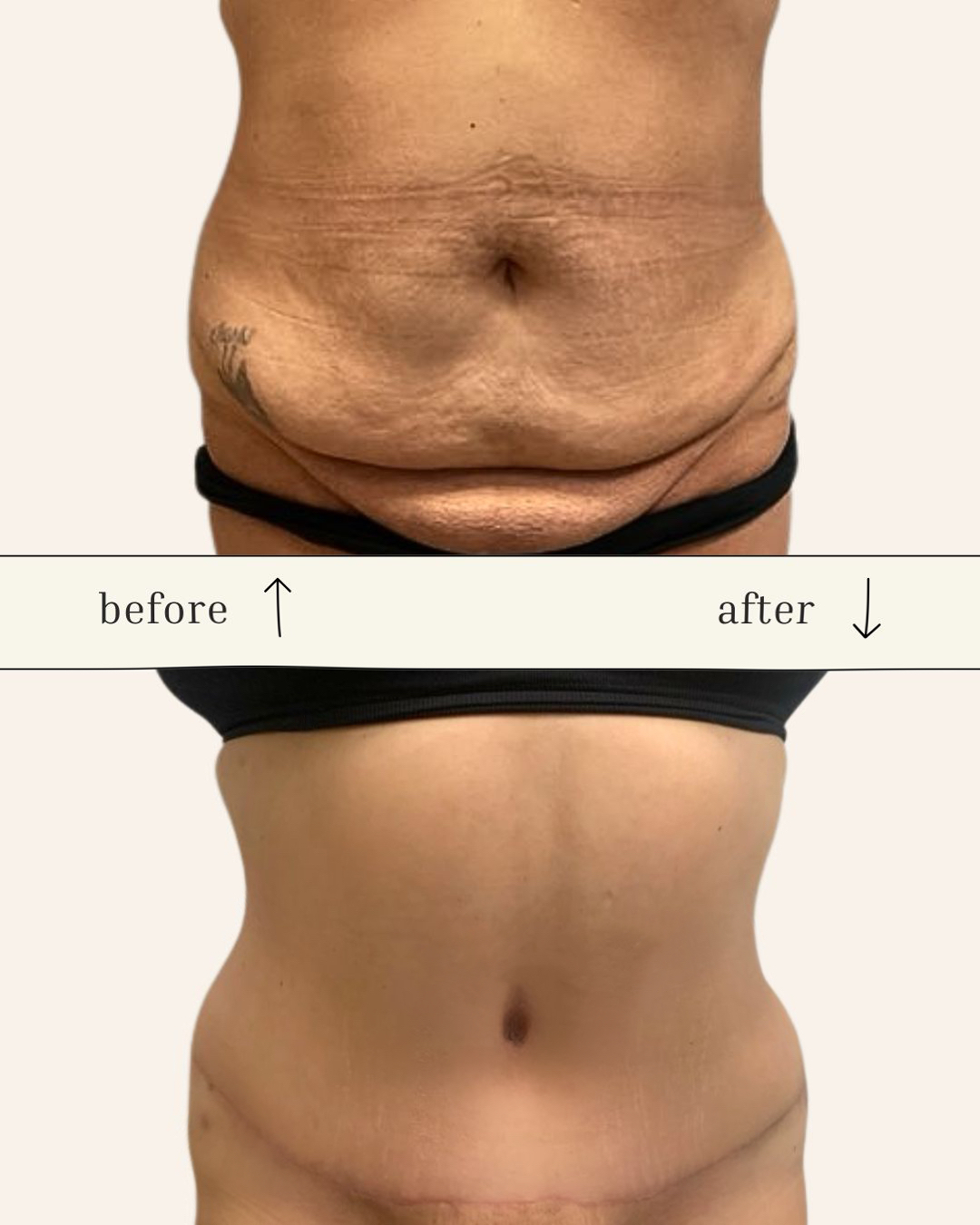 Tummy Tuck before and after - after
