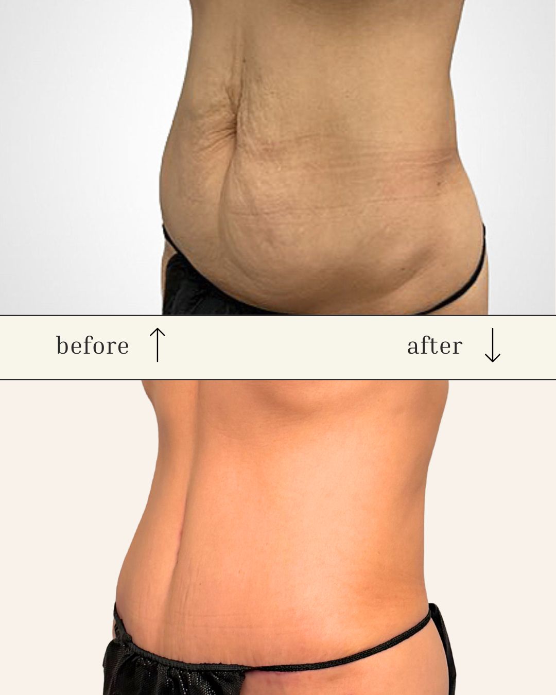 Tummy Tuck before and after - after
