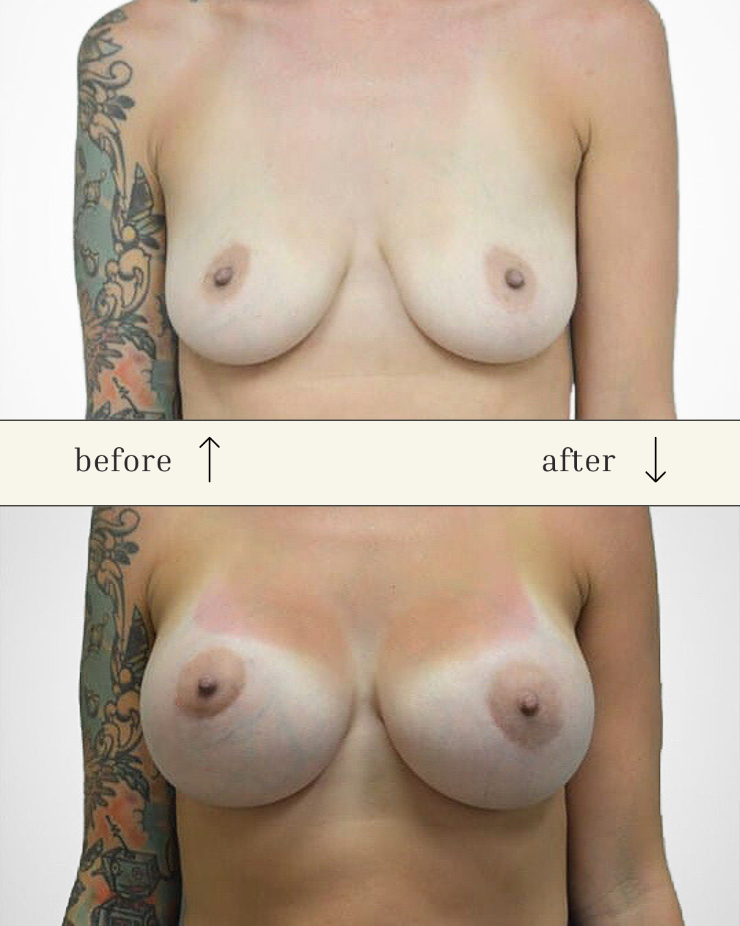 Breast Augmentation before and after - after