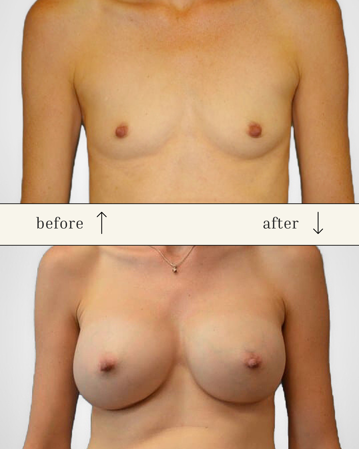 Breast Augmentation before and after - before