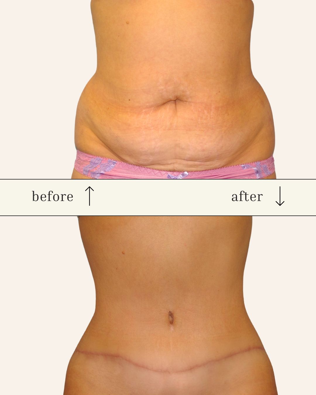 Tummy Tuck before and after - before
