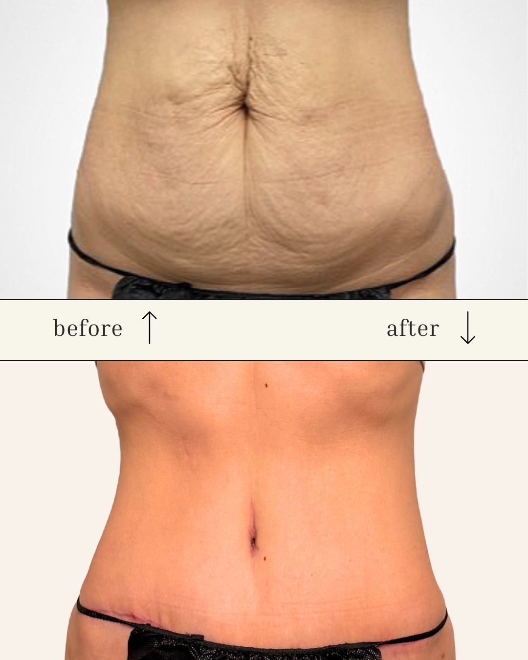 Tummy Tuck before and after - before