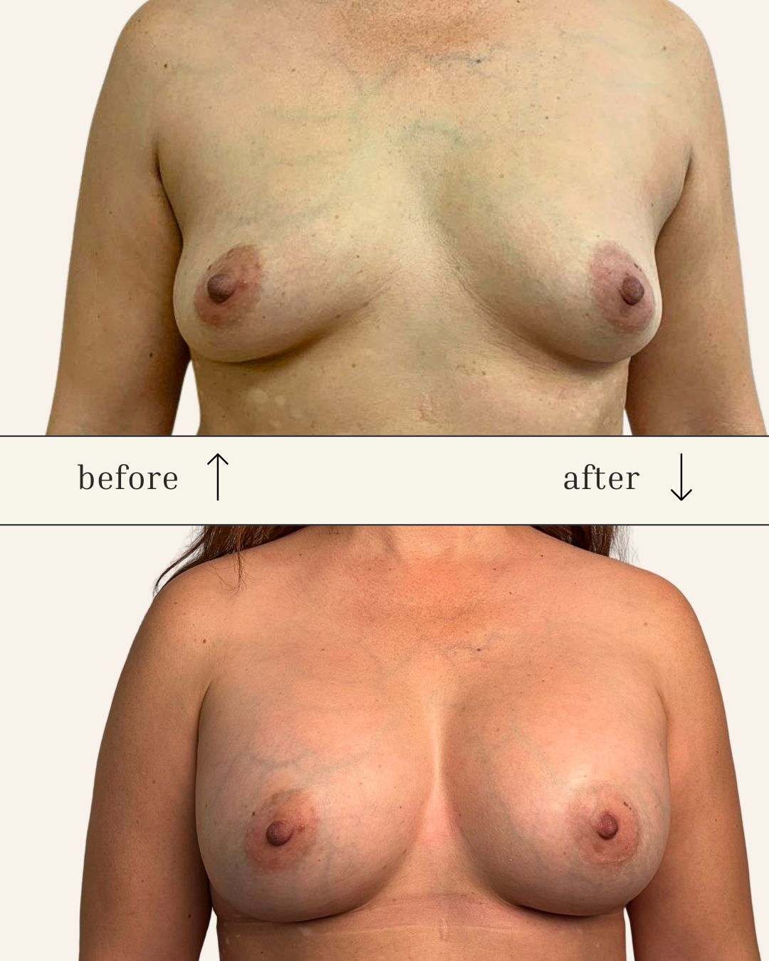 Breast Augmentation before and after - before