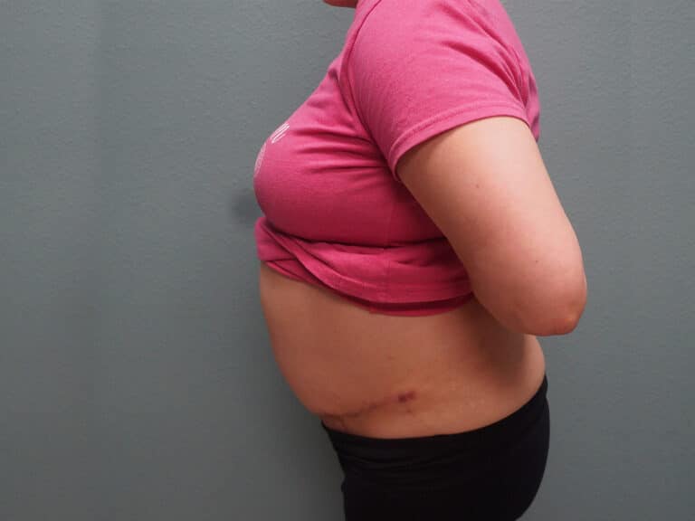Procedure before and after - after