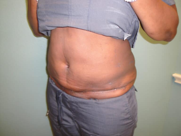 Procedure before and after - after
