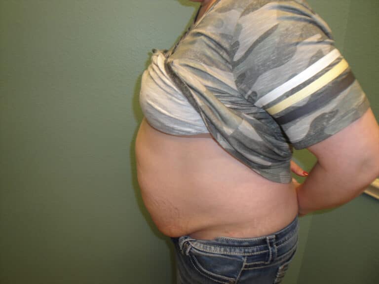 Procedure before and after - before