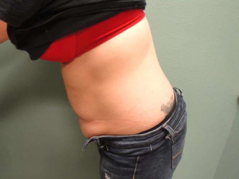 Procedure before and after - before